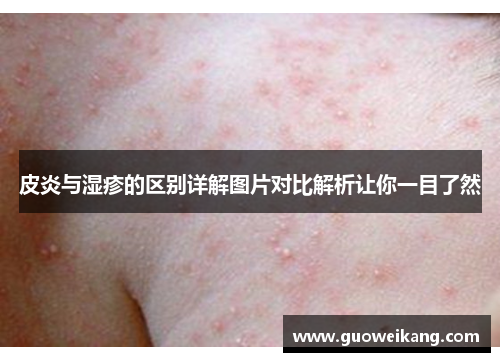 皮炎与湿疹的区别详解图片对比解析让你一目了然